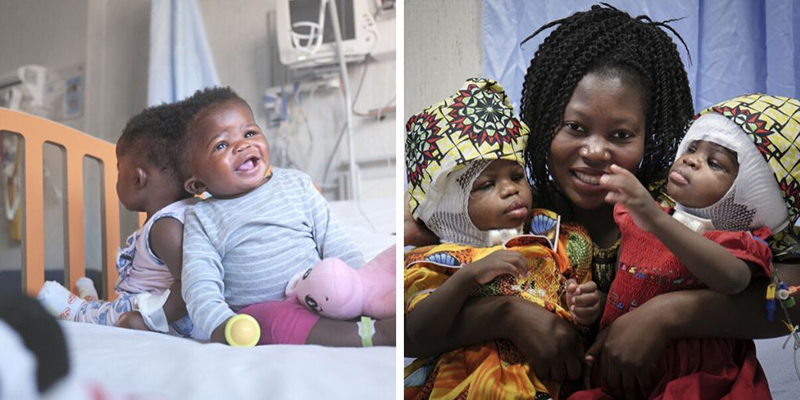 Le gemelle siamesi Ervina e Prefina unite alla testa e separate compiono 4 anni