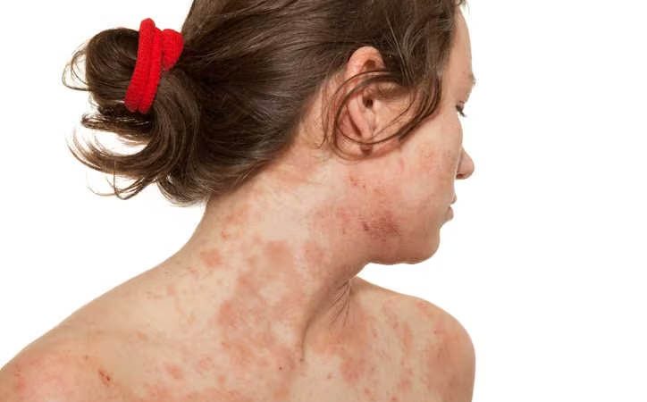OPEN DAY sulla Dermatite Atopica con consulti gratuiti in tutta Italia