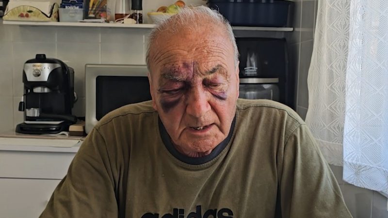 FORIO, UOMO RISCHIA DI ESSERE INVESTITO E SBATTE FACCIA A TERRA: VOLTO TUMEFATTO MA È VIVO