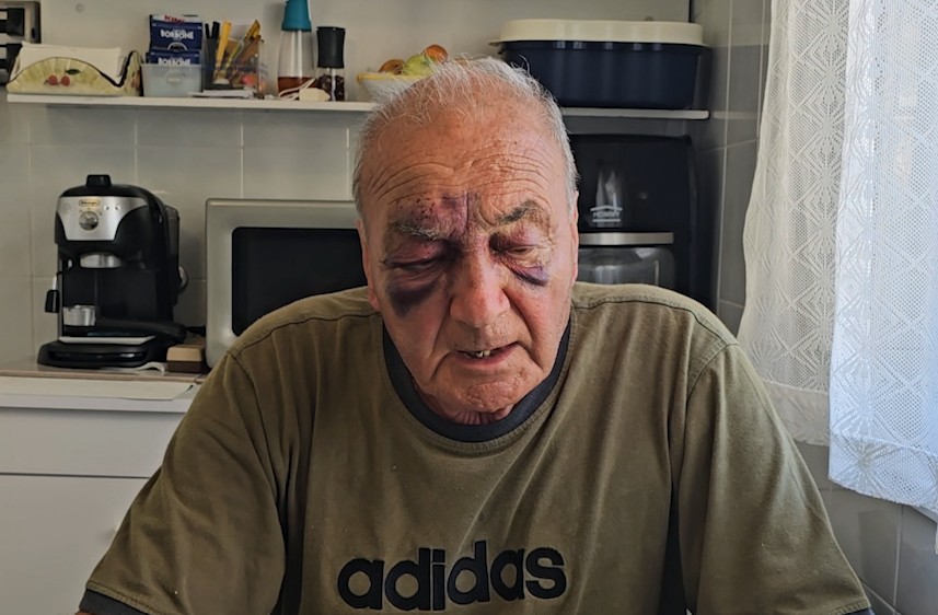 FORIO, UOMO RISCHIA DI ESSERE INVESTITO E SBATTE FACCIA A TERRA: VOLTO TUMEFATTO MA È VIVO